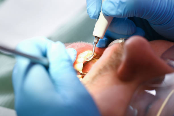 Best Emergency Root Canal Treatment in Chinook, MT