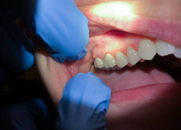 Best Emergency Dentist for Knocked-Out Tooth in Chinook, MT